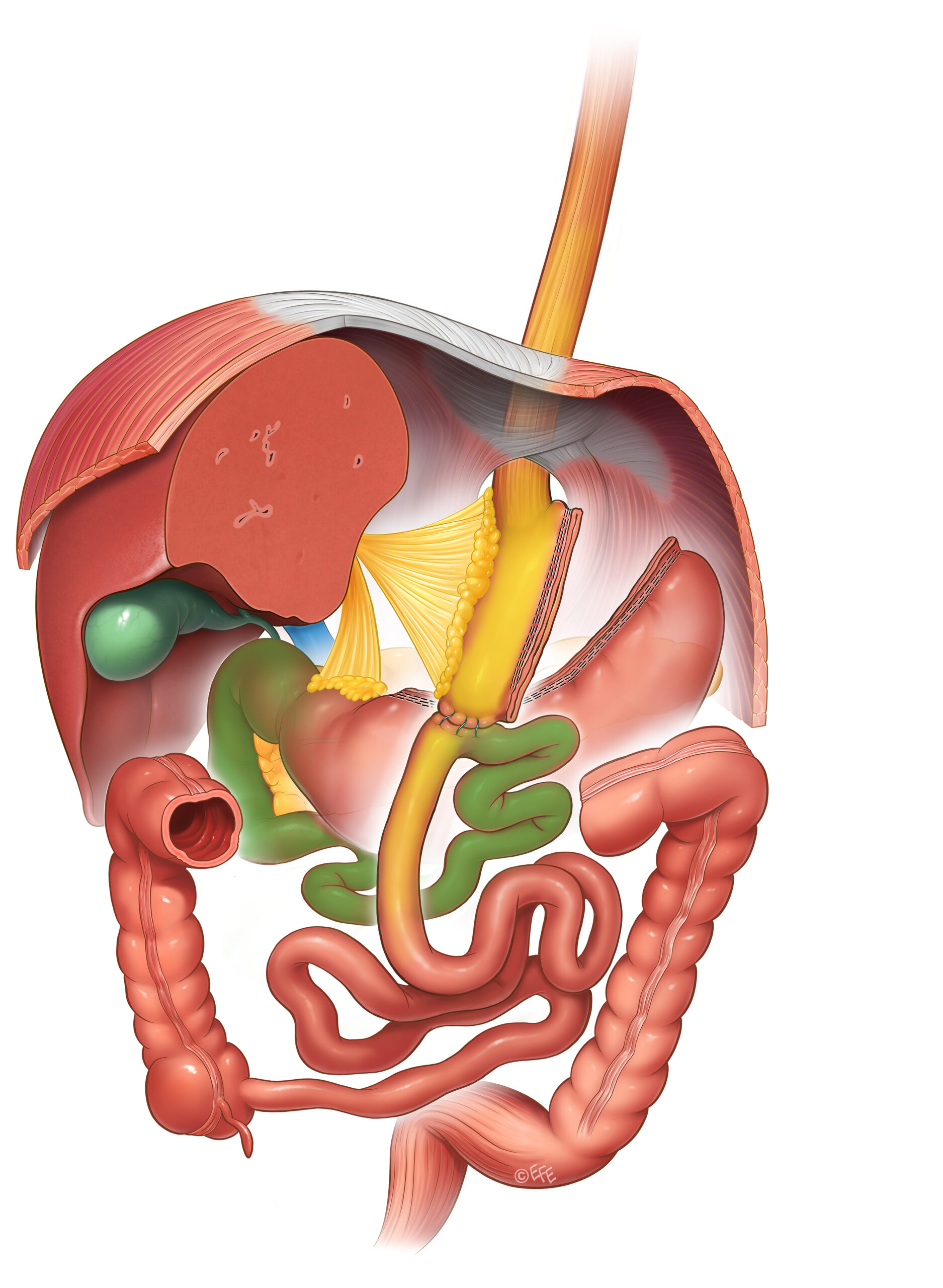 International Federation for the Surgery of Obesity and Metabolic Disorders International Federation for the Surgery of Obesity and Metabolic Disorders
